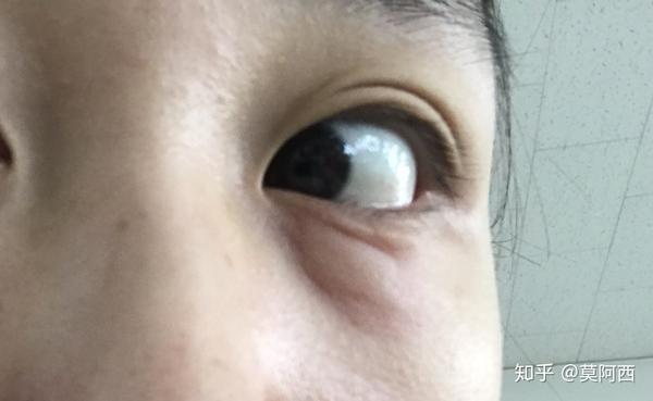 下眼袋突然肿起来是什么回事 下眼角突然肿了咋回事 趋势网络