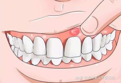 下牙龈牙床溃疡图片图片