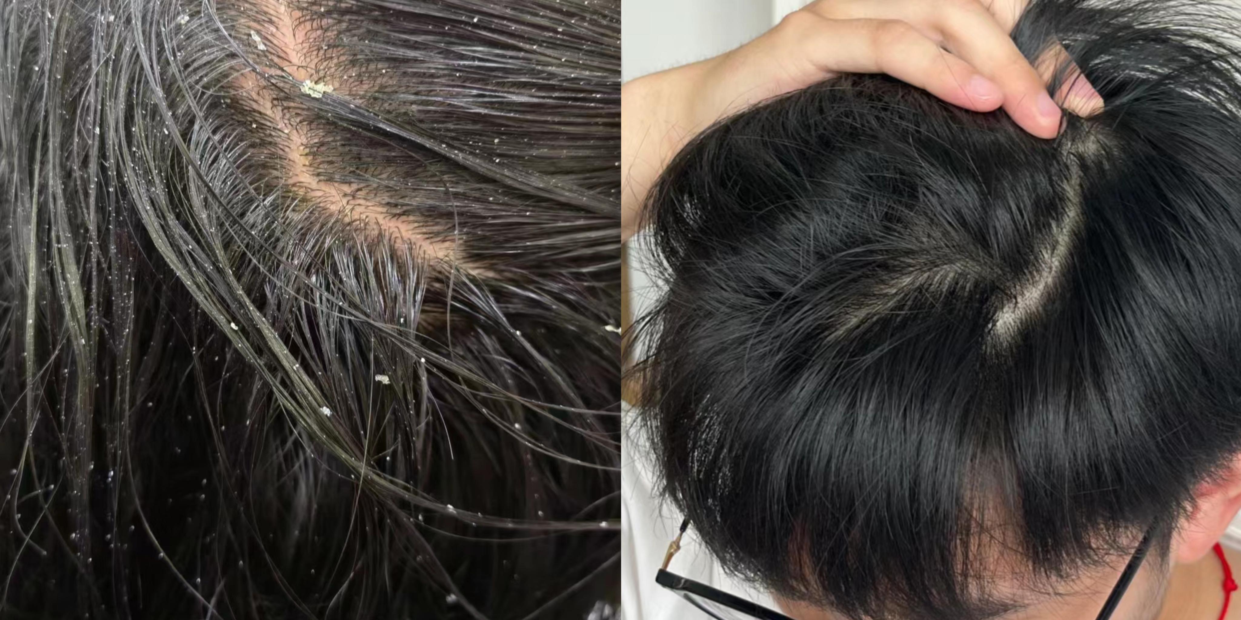 男生如何去屑止痒?一直用二硫化硒洗剂去屑,依赖性太强不说,头皮还不耐受,关键是停用就反复!【皮肤科医生】教你3步改善头屑头痒,一个月还原清爽 ...