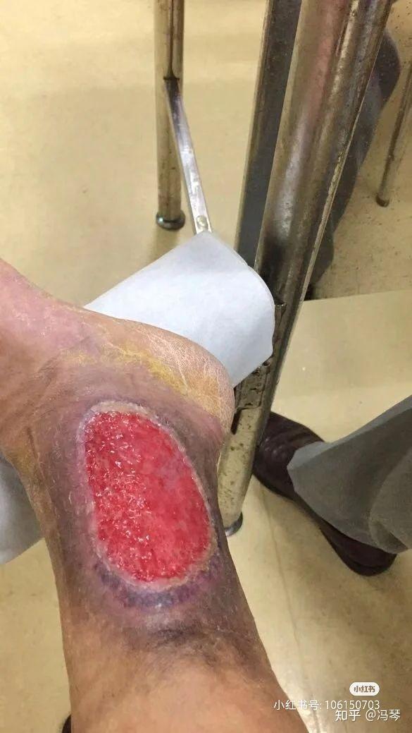 老烂腿治疗