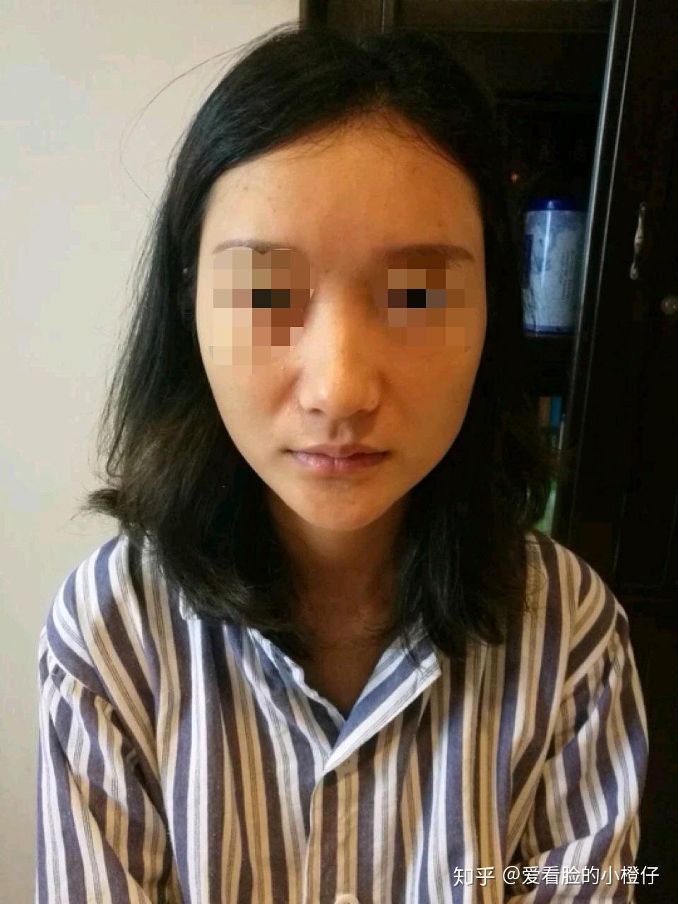 分享肋软骨隆鼻术后体验及恢复规程 - 知乎