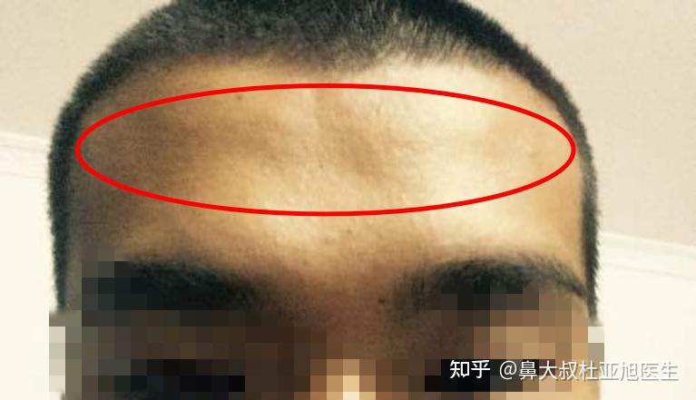 额头凹陷是怎么形成的?有哪些改善方法? - 知乎