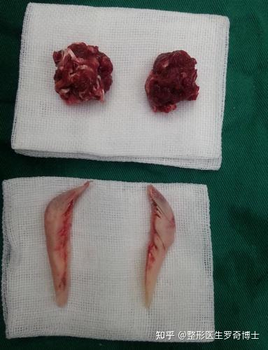 局部麻醉下磨骨瘦脸下颌角削骨手术过程