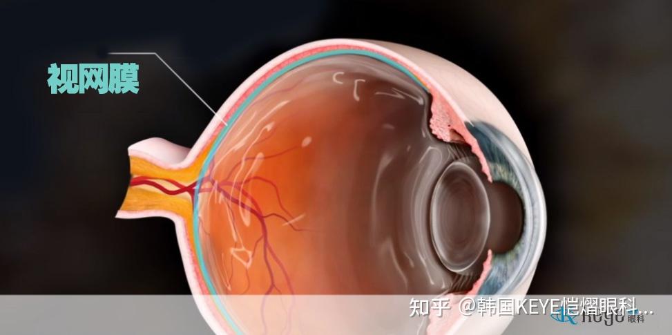 视网膜脱落视网膜疾患治疗的几种方法