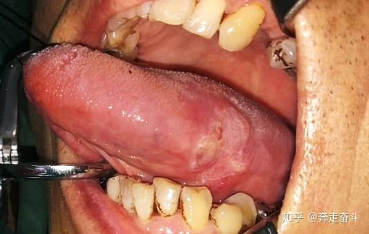 舌癌的早期症状和前兆图片