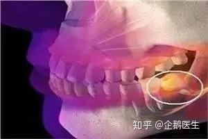 扁桃体请坐下 下面有请智齿发炎 知乎