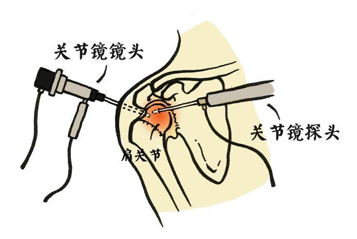 目前主流的手术治疗方式就是关节镜下的关节囊松解术,这是一个微创的