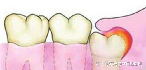 智齿冠周炎自己怎么处理？教你六个实用小技巧，赶紧get起来~ - 知乎