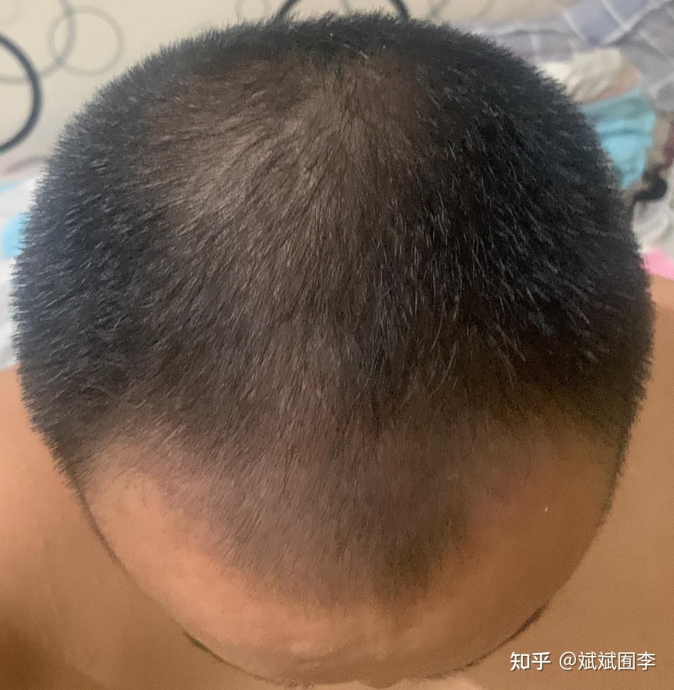 一个三十岁的中年发福男子的生发日记。 - 知乎