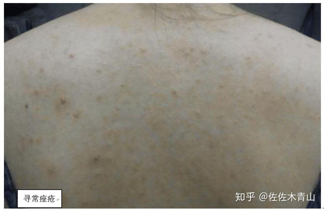 前胸后背的毛囊炎总治不好,可能得的是真菌性毛囊炎 - 知乎