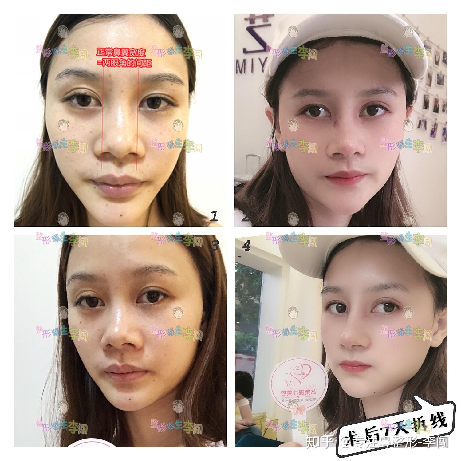 现在来看下鼻翼外切最直观的正面对比,术前和术后7天拆线对比.