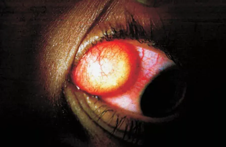 如果遭入侵的是我们的眼睛,便成了眼囊虫病.