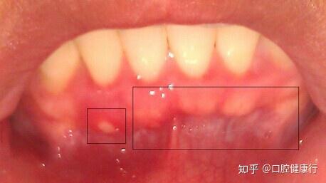 艾滋病患者的牙龈图片图片