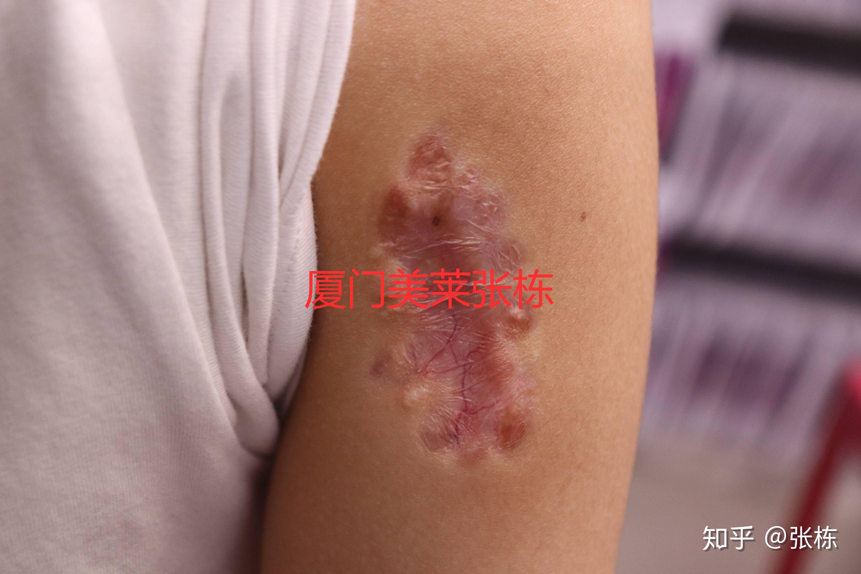 超减张缝合技术在四肢瘢痕中的应用