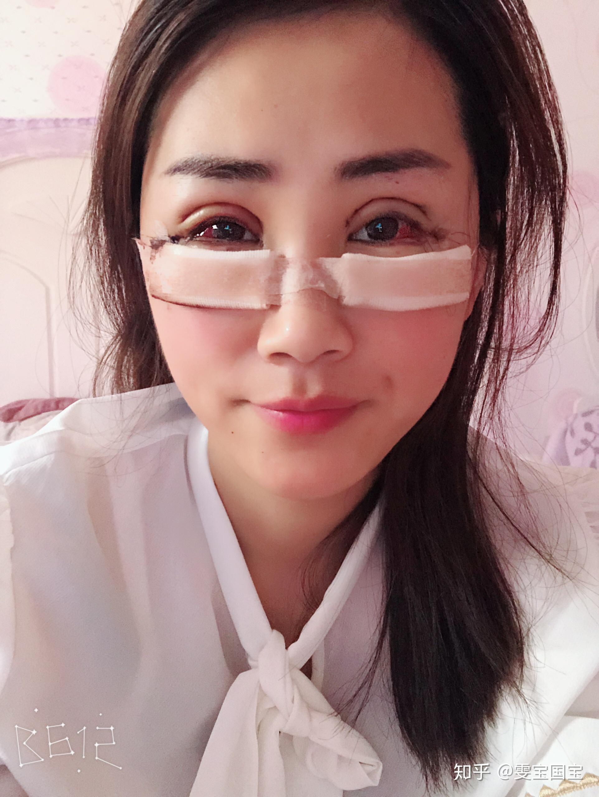 分享:眼综合77去眼袋第二天 - 知乎