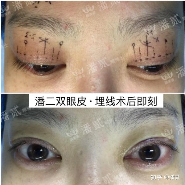 凸眼睛者：眼球突出高于眉骨、上睑凹陷和（或）多层，双眼皮设计为何不宜过宽？ - 知乎
