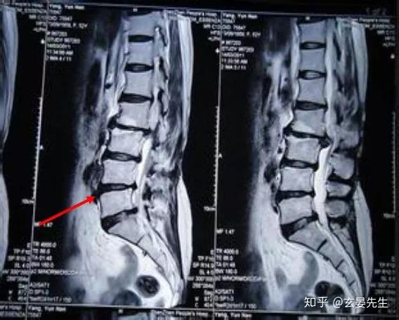 腰椎间盘突出症诊断与治疗 很详细！ 知乎