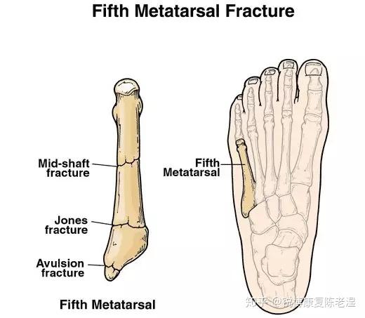 足底最可怕的伤 第五趾骨疲劳性骨折 知乎