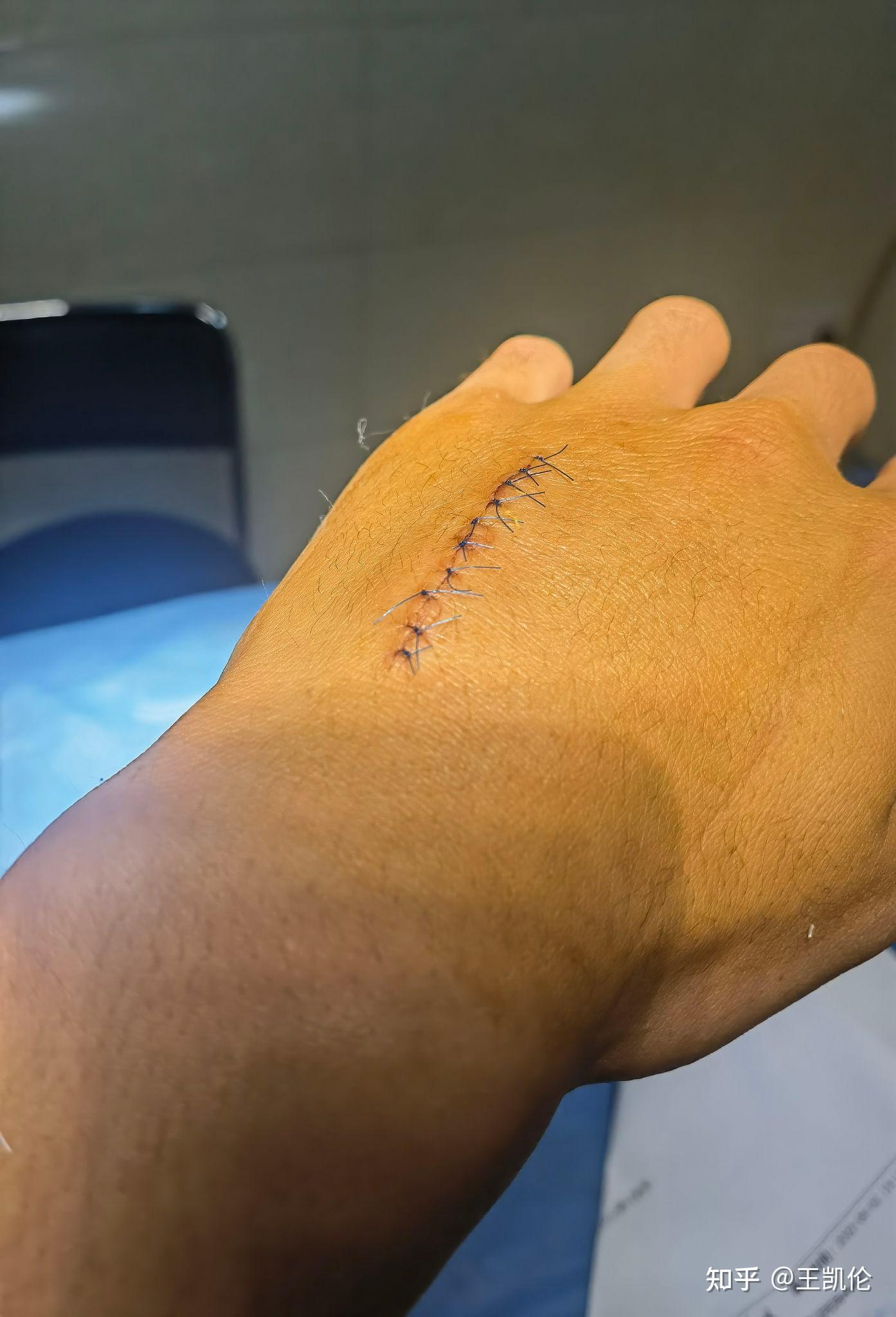 掌骨骨折手术疤痕图片图片