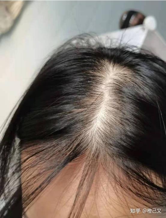 请问女生经常掉头发,会不会把头发掉光了?