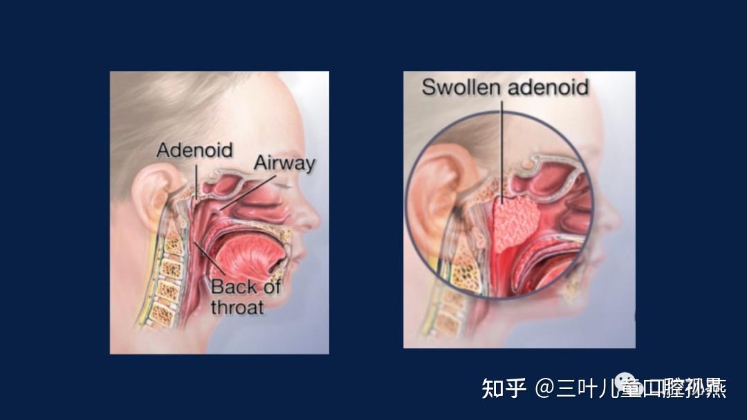 父母需要關注的兒童顏值殺手腺樣體面容