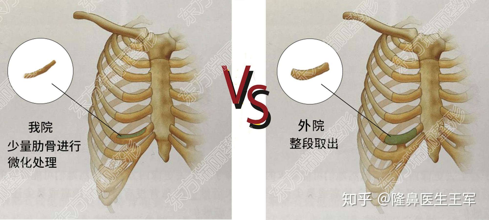 肋骨隆鼻鼻软骨会与取下的肋骨长在一起不怕碰大概用多久能长在一起有