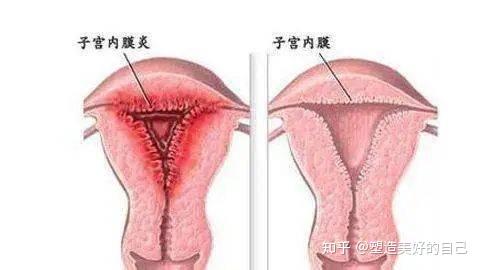 女性淋病下面 妇科图片