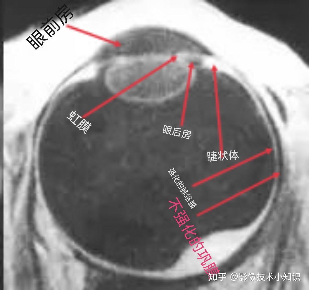 眼的CT解剖 - 知乎