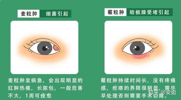 眼睑红肿、疼痛，如何治疗麦粒肿？ - 知乎