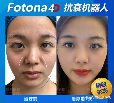 fotona4d对人体有害吗