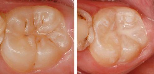 宝宝的牙齿应该什么时候做窝沟封闭呢窝沟封闭的定义和作用是什么