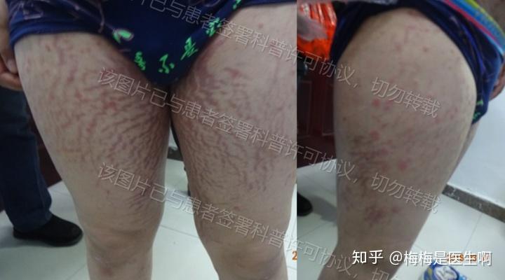 银屑病使用激素药就会长激素纹?