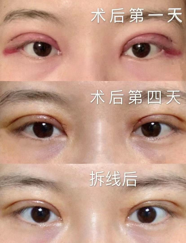 北京双眼皮100天了 给大家康康 - 知乎