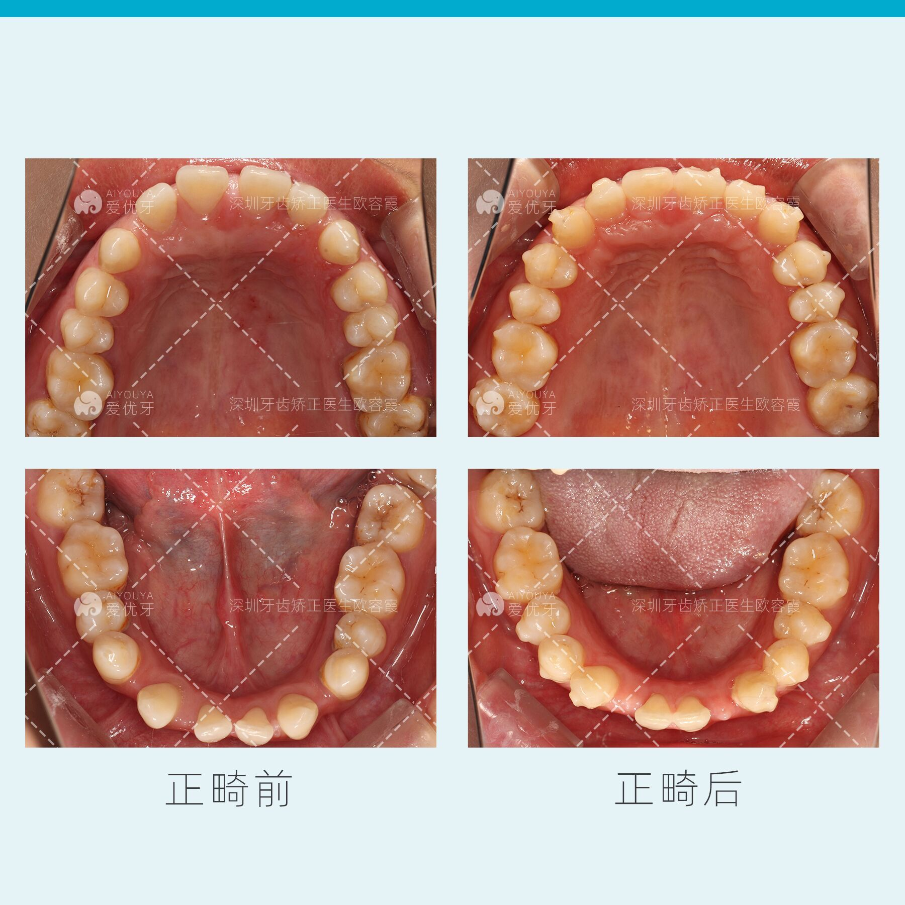 深圳牙齒矯正深圳整牙牙周正畸種植聯合治療案例分享