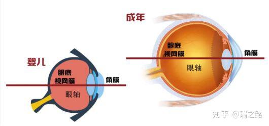 眼軸增長1mm近視增加300度