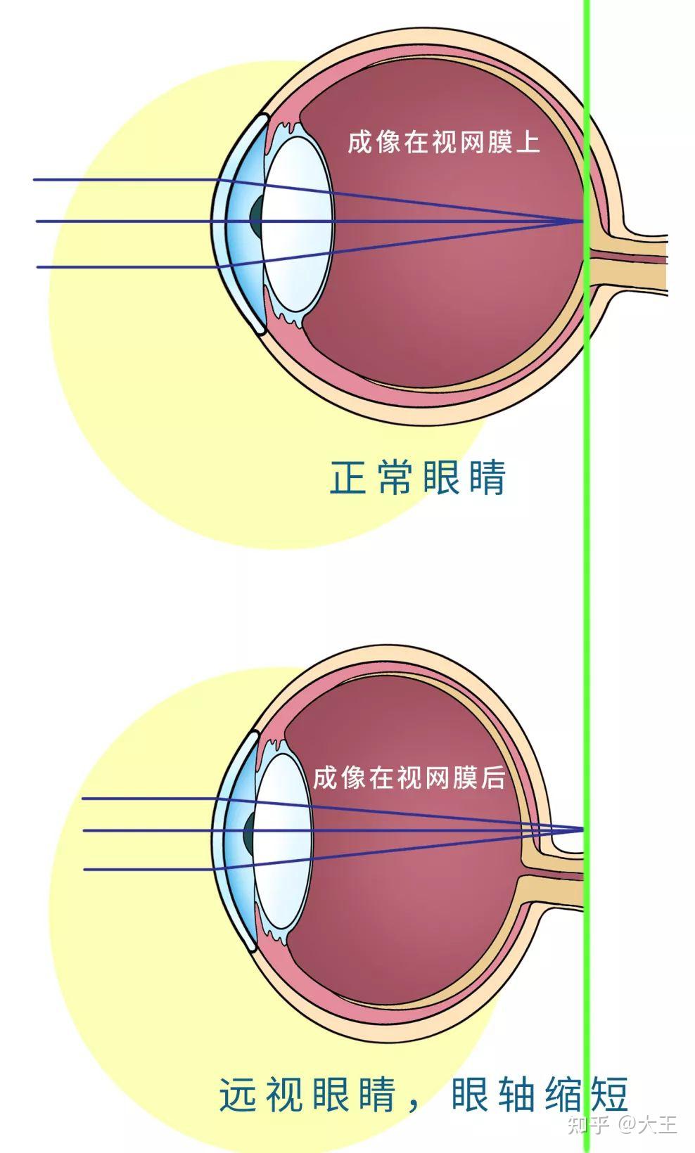 远视眼是怎么回事图片