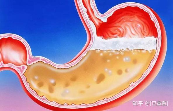 日常生活胃酸過多燒心鬧得慌讓我們為腸胃加一把安全鎖