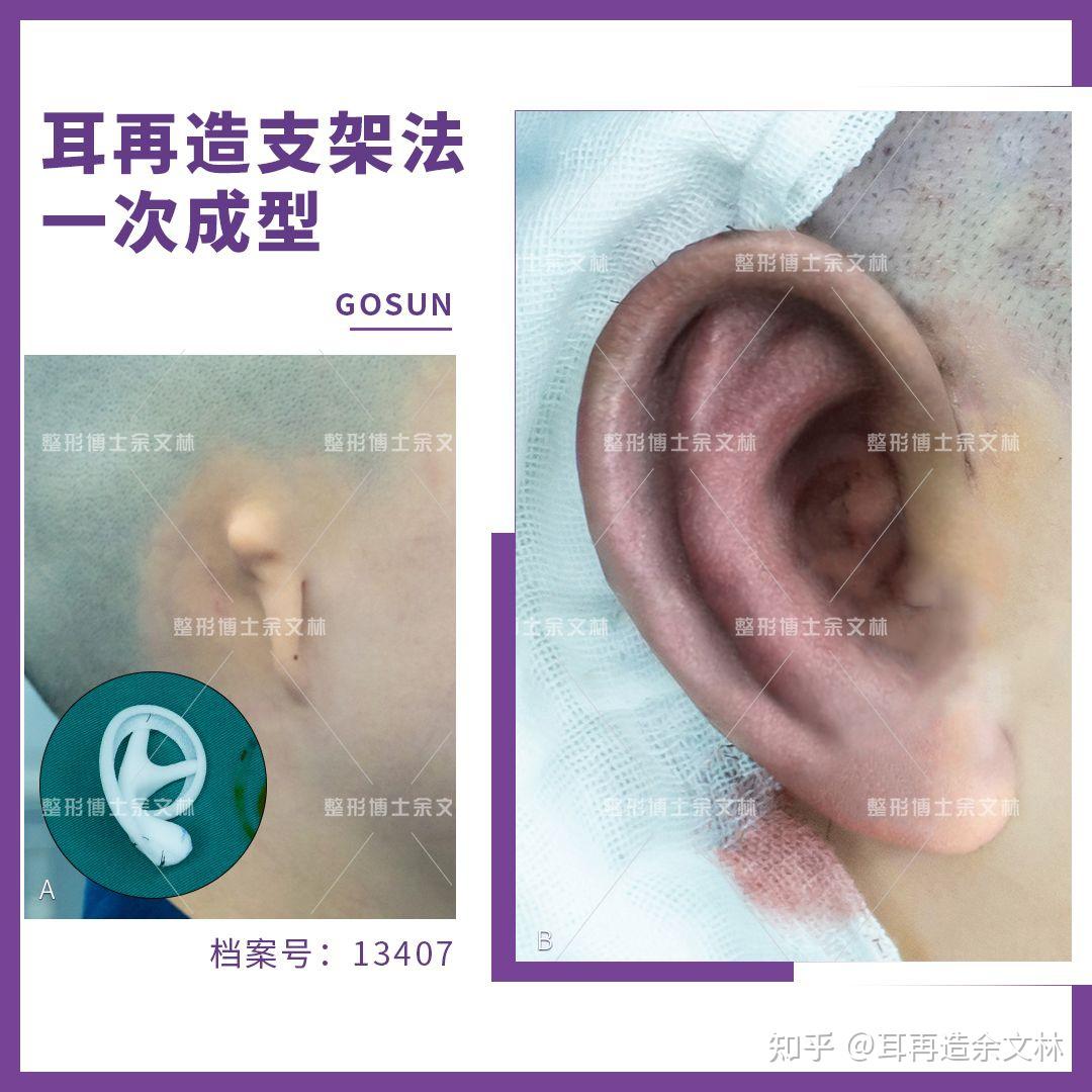 【案例分析】26岁男子耳朵受伤，做部分耳再造手术重获完好耳朵 - 哔哩哔哩