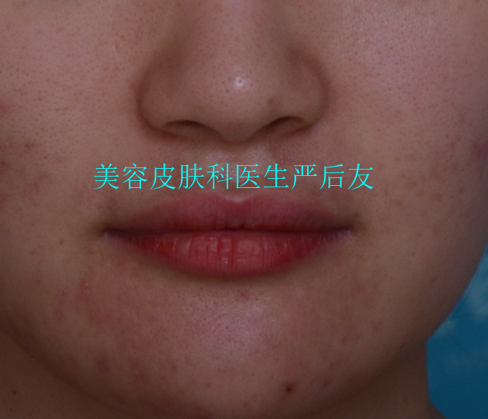 几颗晒斑外,黑褐色痘印(痤疮后色素沉着)和颈部几颗红色痘痘基本消退