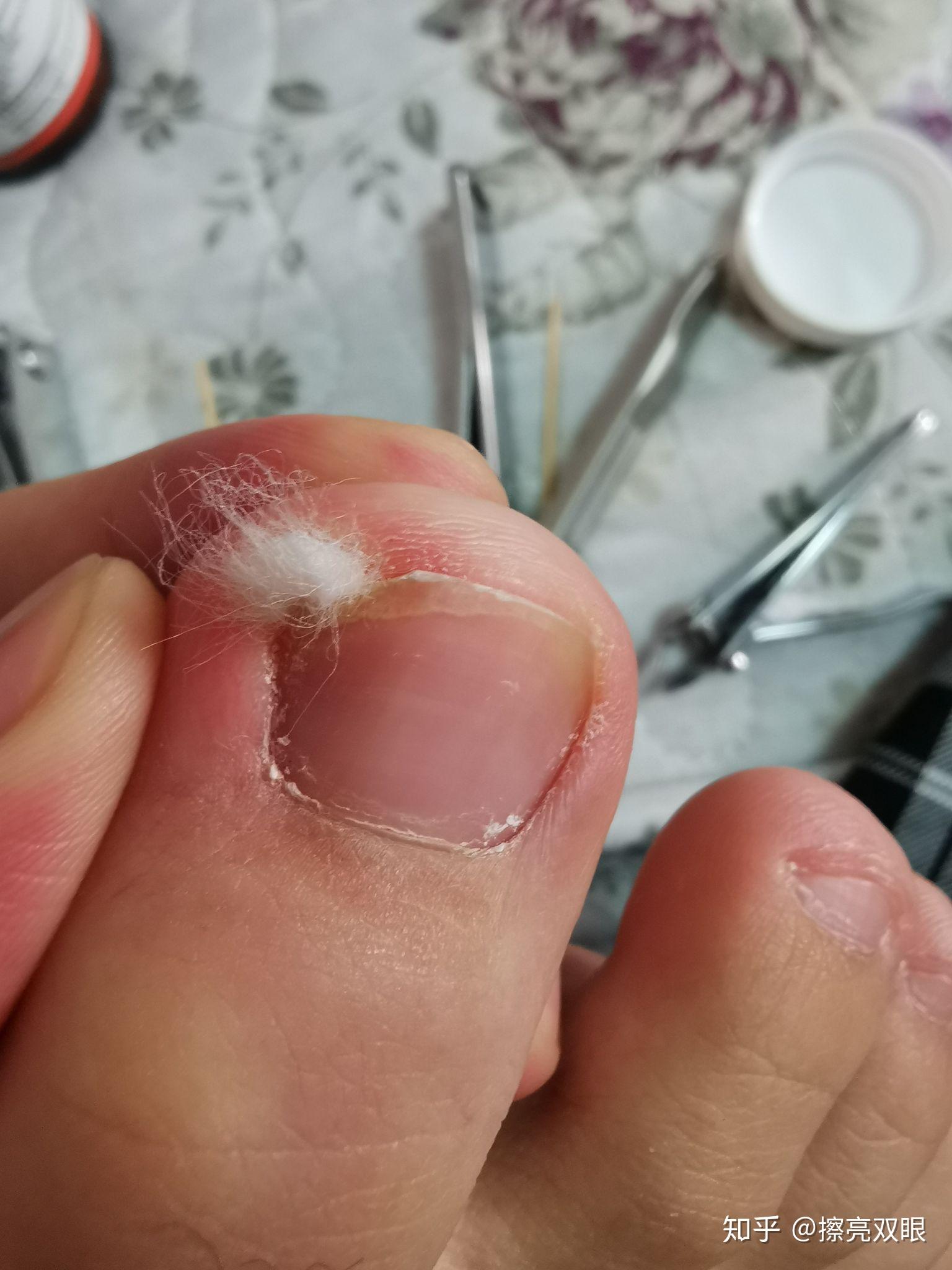 希望能提供给甲沟炎的同胞一些帮助