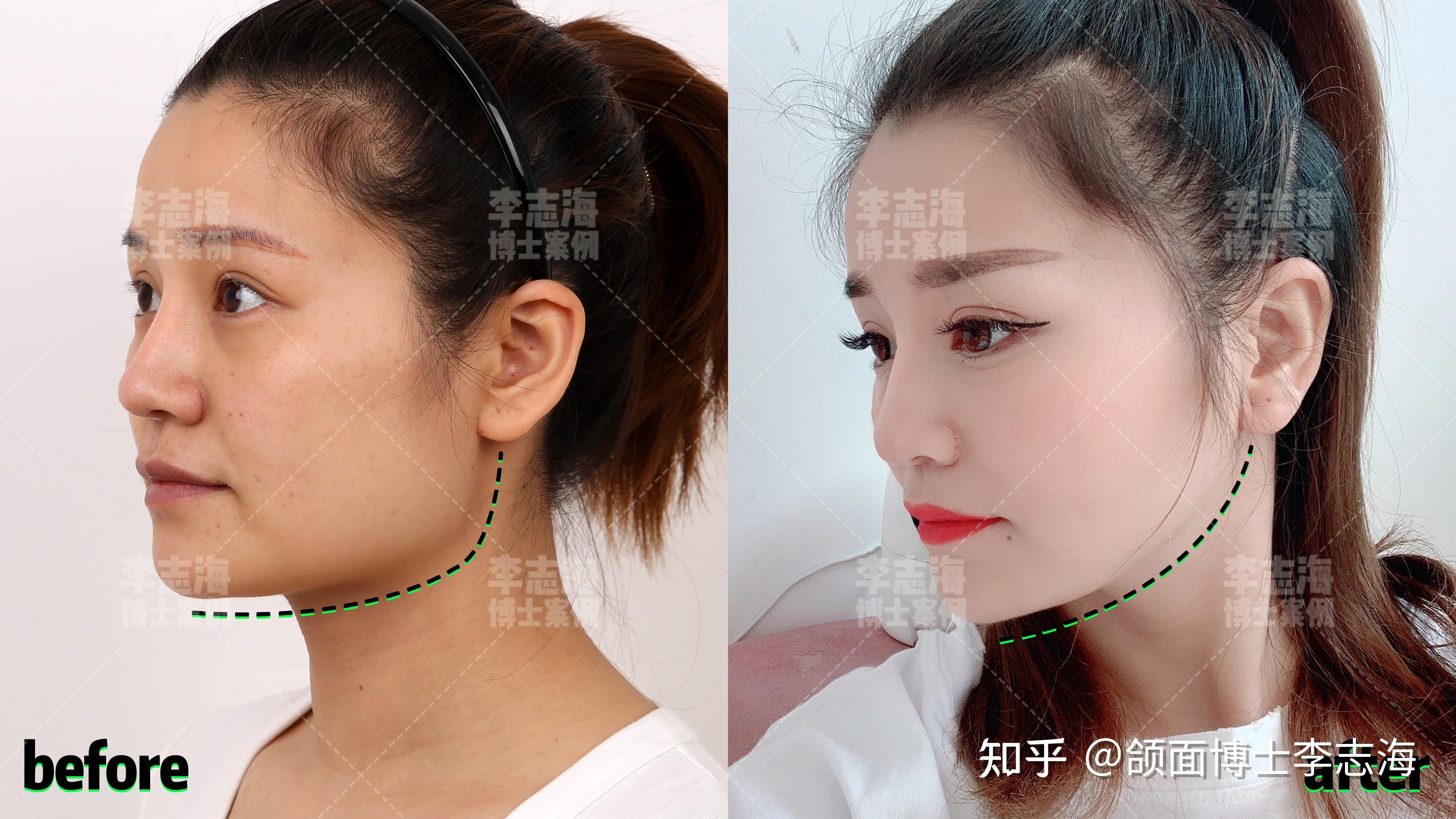 下颌角正面较宽,侧面拐点偏低,轮廓呈方形,自述想要轮廓改善的更加