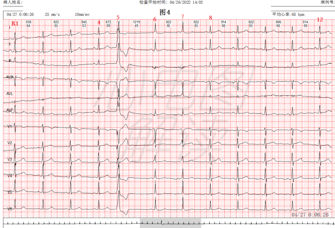 心室预激心电图图片