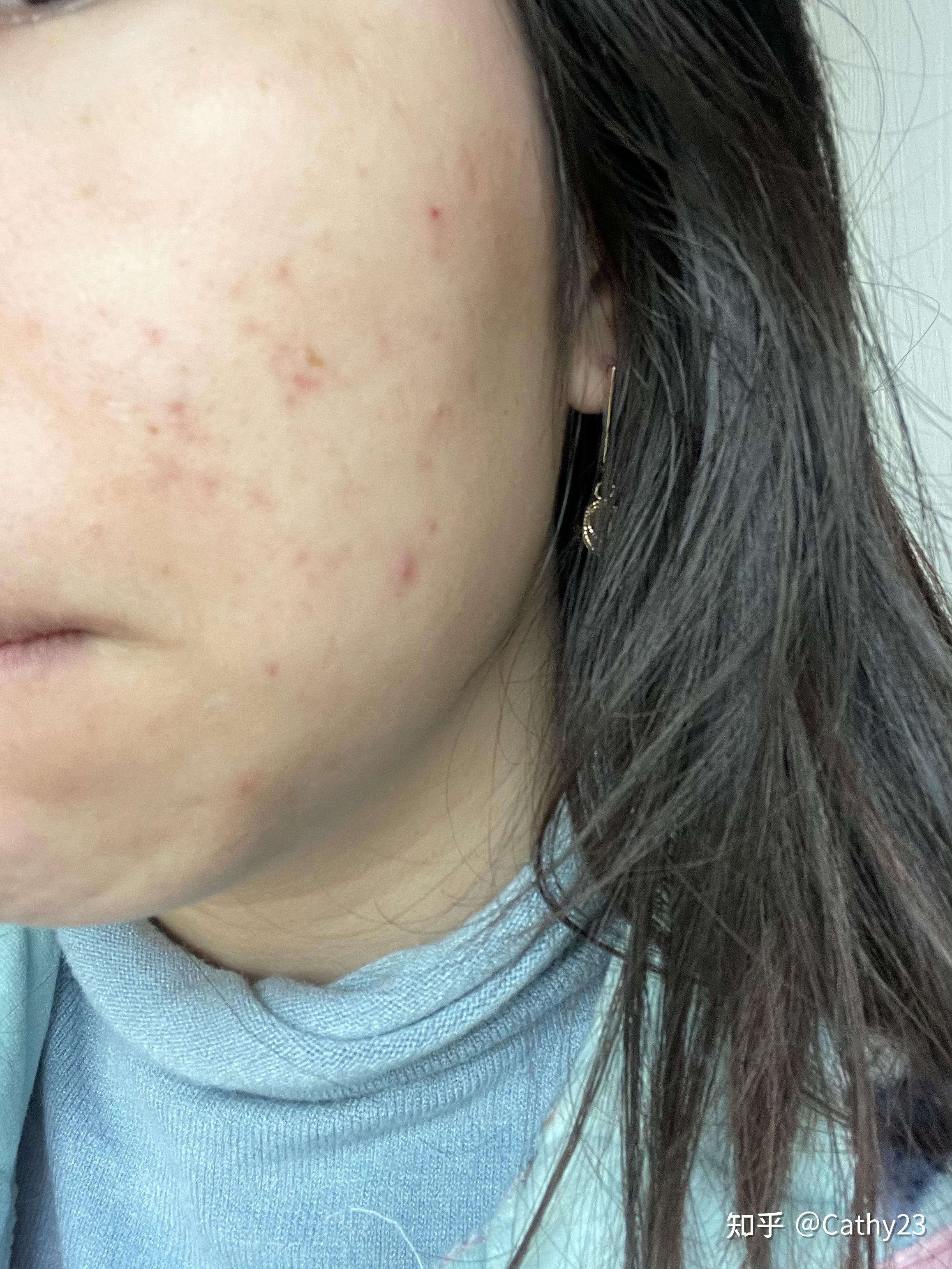 长痘有痘印去医院～湘雅附二皮肤科就诊和刷酸体验 - 知乎