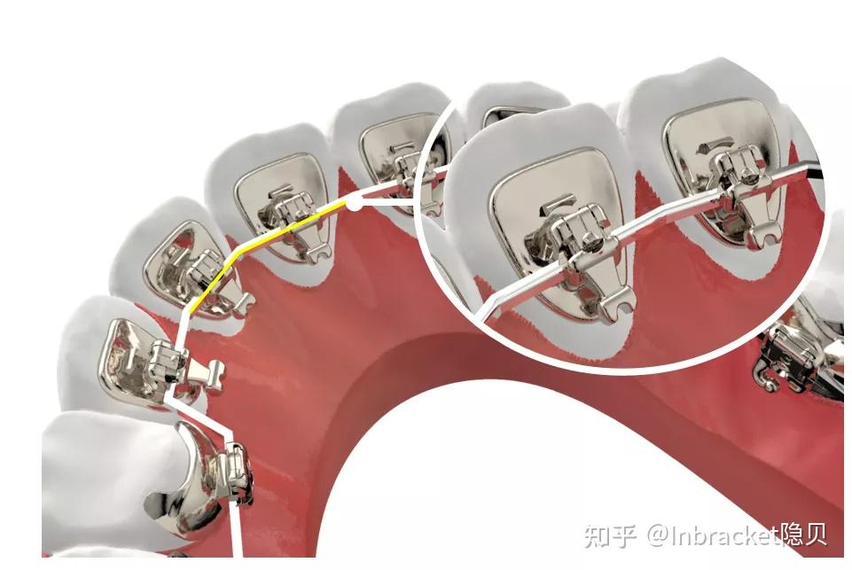 舌隆突支托图片图片