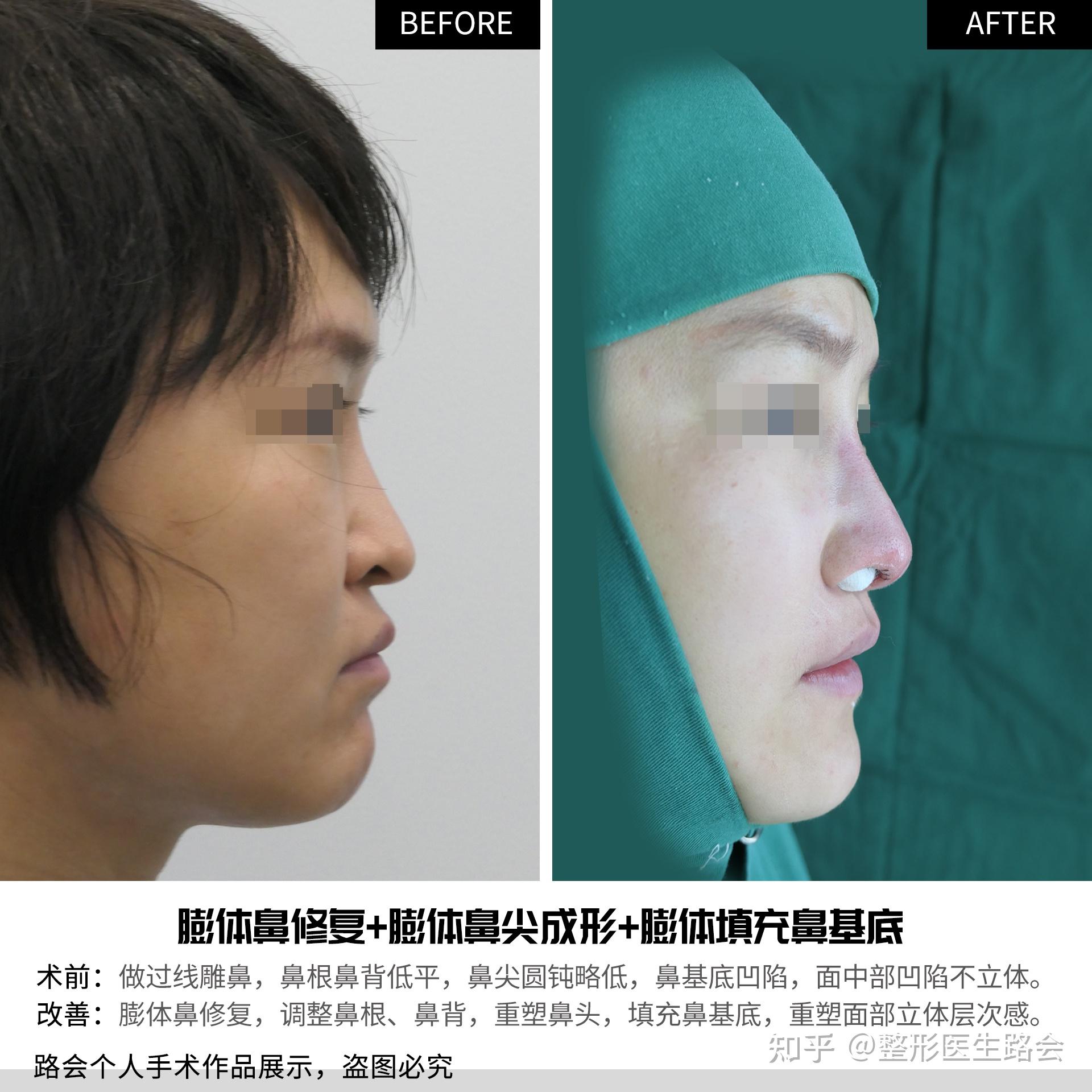 20岁姑娘膨体隆鼻记录：术前、术后即刻、第55天效果变化