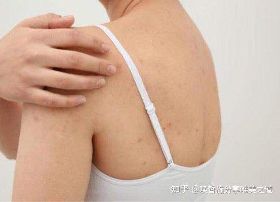 去鸡皮肤最有效的方法日常(去鸡皮肤最有效的方法日常用) 去鸡皮肤最有效的方法日常(去鸡皮肤最有效的方法日常用)