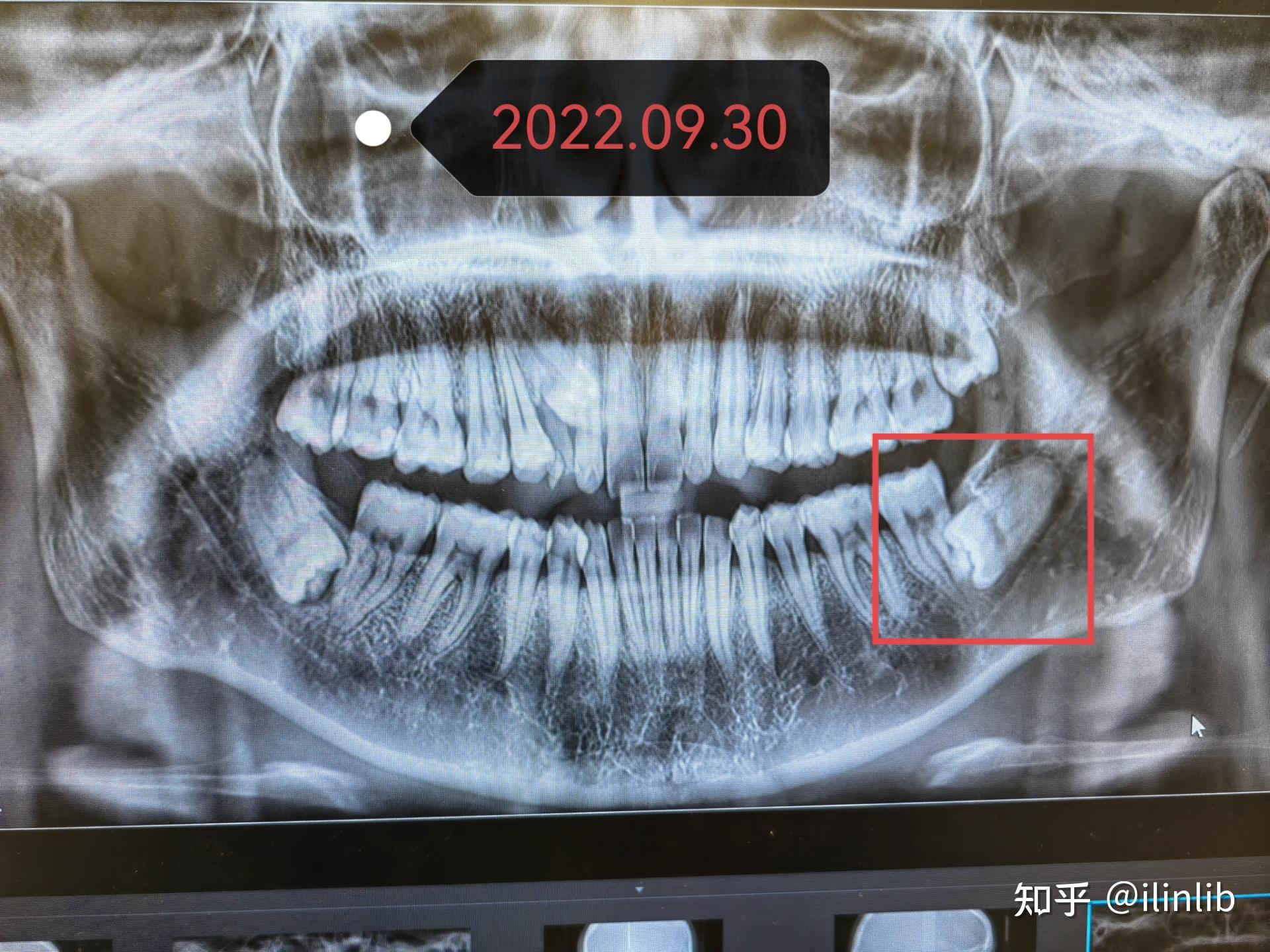超超低位阻生智齿拔牙经历