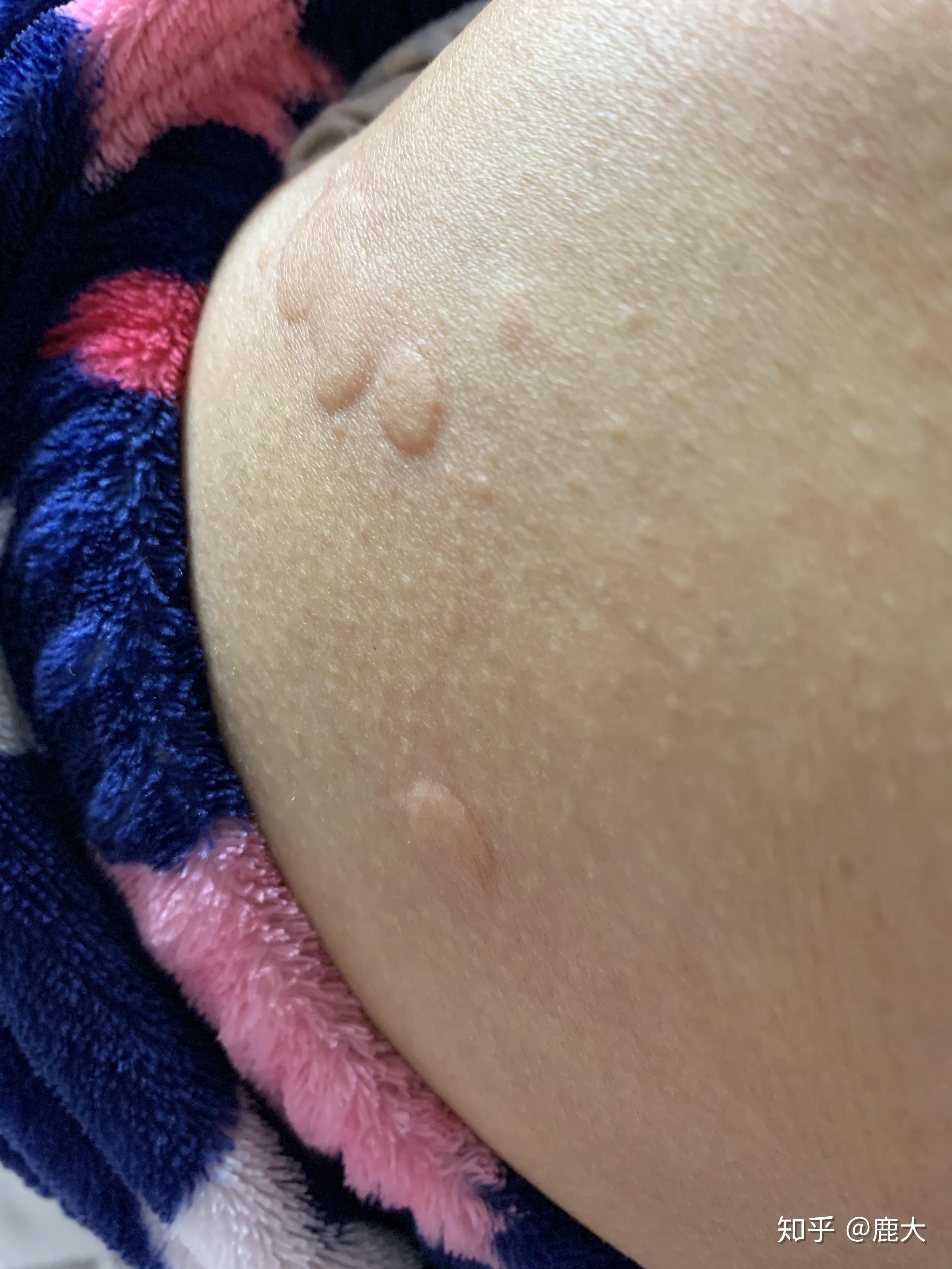 急性荨麻疹治愈 - 知乎