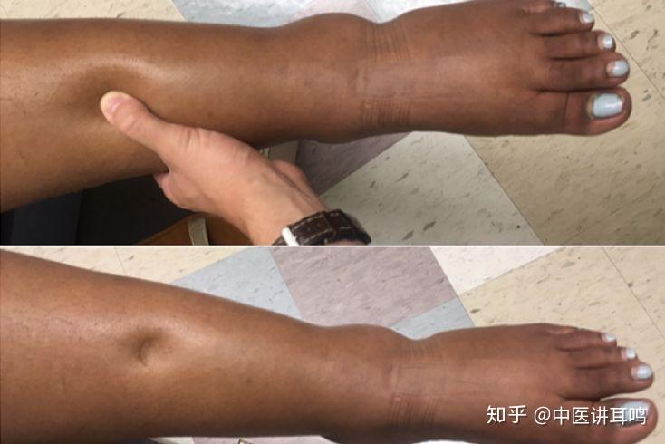 一进医院就是肾衰竭肾病早期症状你关注了吗