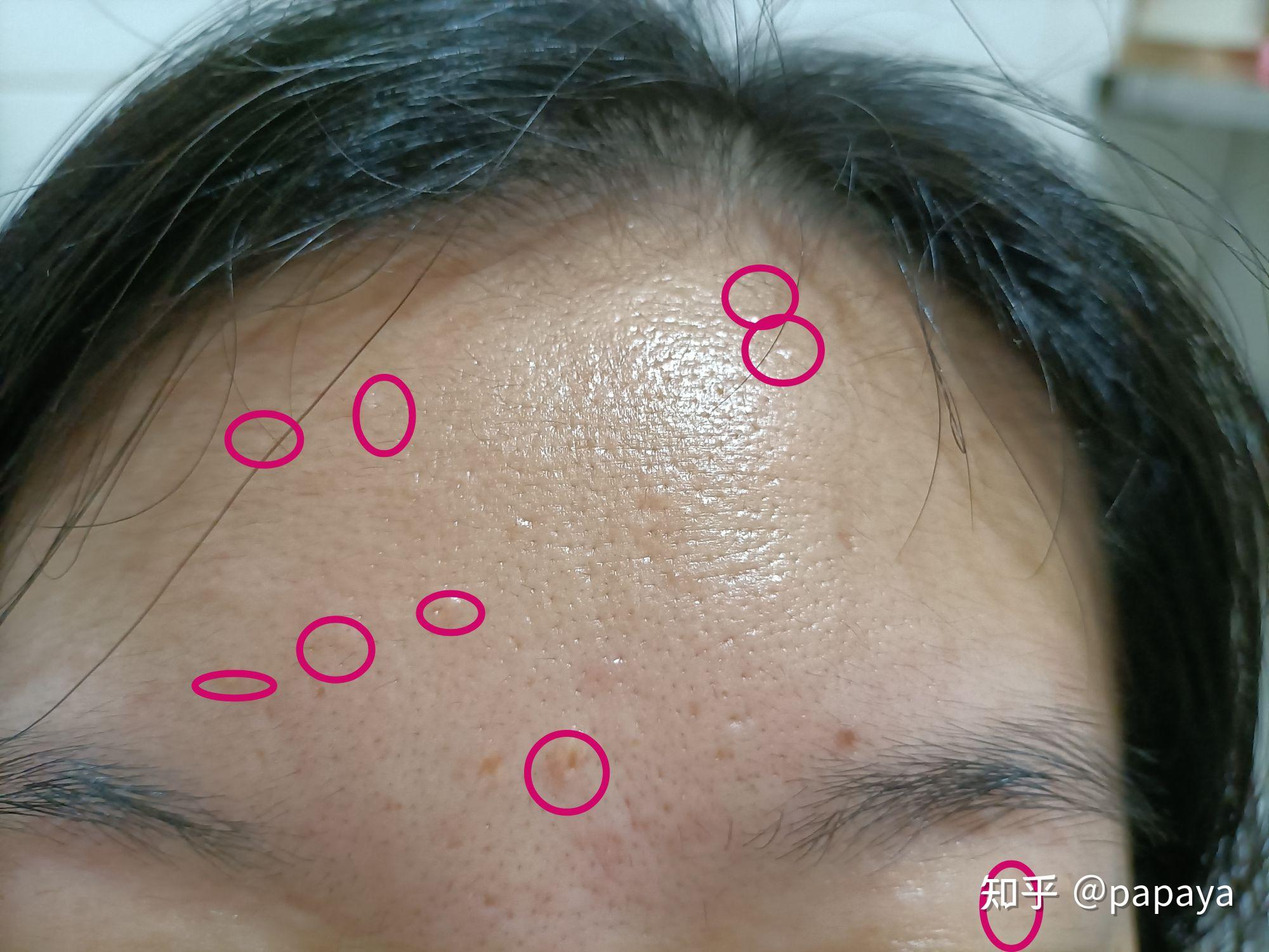 激光点皮脂腺增生记录0916 - 知乎